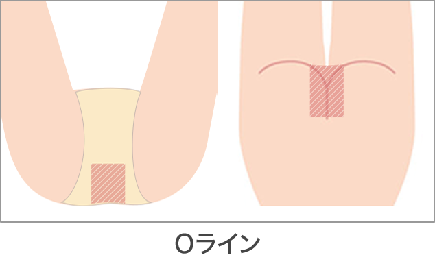 脱毛 部位 Oライン