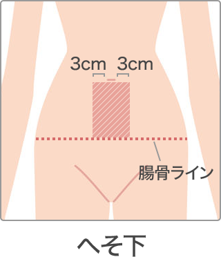 脱毛 部位 へそ下