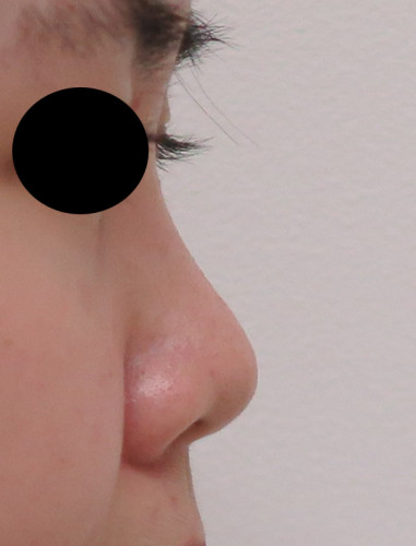 鼻尖形成、軟骨移植（耳珠）　手術前　右側面