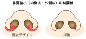 鼻翼縮小（内側法＋外側法）切開線