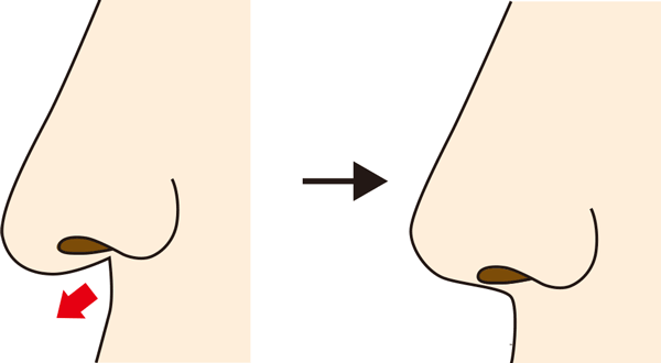 鼻柱基部下降の変化のイメージ