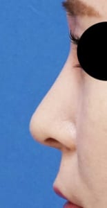 鼻尖縮小・耳介軟骨移植・ストラット⑤　左側面　１か月後
