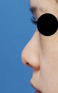 鼻尖縮小・耳介軟骨移植　左側面　術前