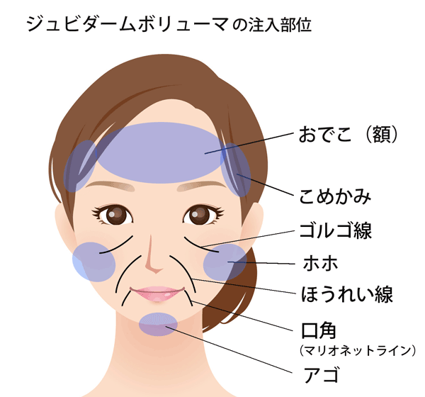 ボリューマ注入部位