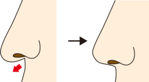 鼻柱基部軟骨移植の変化