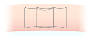 二重埋没法　マルティプルノット法の図