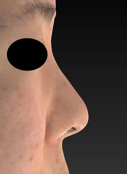 鼻尖縮小、軟骨移植、ストラット、鼻翼縮小（内側＋外側）　右側面　手術前