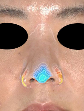鼻尖縮小、軟骨移植、ストラット、鼻翼縮小（内側＋外側）　正面　3D解析