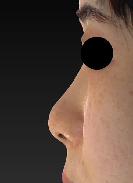 鼻尖縮小（３D法）、ストラット、軟骨移植　手術前　左側面