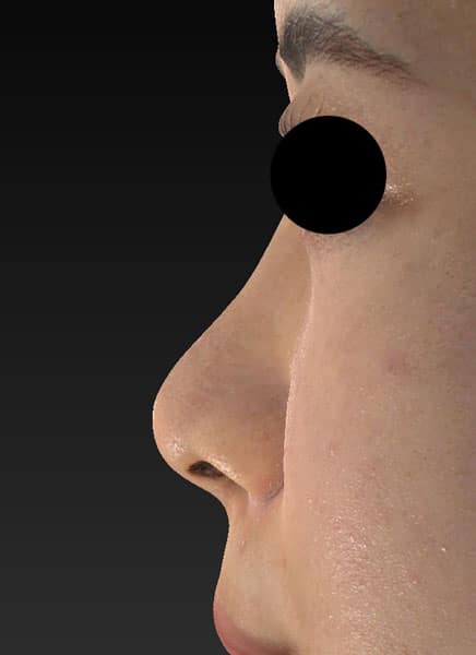 鼻尖縮小（３D法）、ストラット、軟骨移植　半年後　左側面