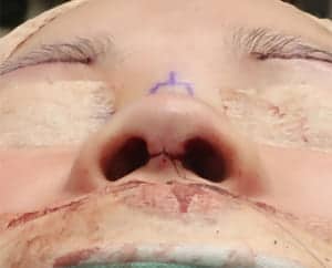 鼻中隔延長、鼻尖軟骨移植、鼻尖縮小、Ｉ型プロテーゼ　手術前　下から