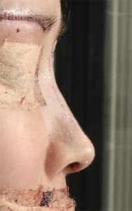 鼻中隔延長、鼻尖軟骨移植、鼻尖縮小、Ｉ型プロテーゼ　手術直後　右側面