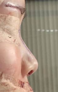 鼻中隔延長、鼻尖軟骨移植、鼻尖縮小、Ｉ型プロテーゼ　手術前　右側面