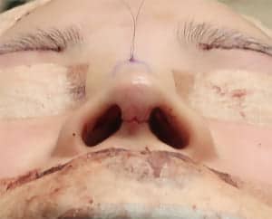 鼻中隔延長、鼻尖軟骨移植、鼻尖縮小、Ｉ型プロテーゼ　手術直後　下から