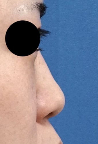 鼻尖縮小、軟骨移植、ストラット、I型プロテーゼ　手術前　右側面