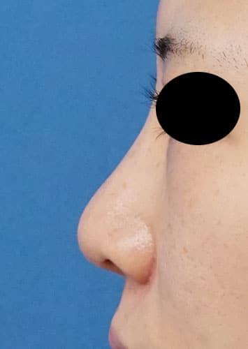 鼻翼縮小（内側＋外側）、鼻尖縮小、軟骨移植　１ヶ月後　左側面