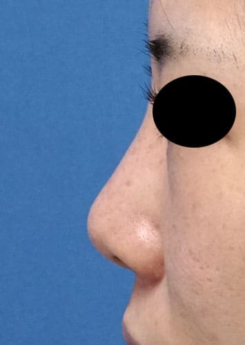 鼻翼縮小（内側＋外側）、鼻尖縮小、軟骨移植　手術前　左側面