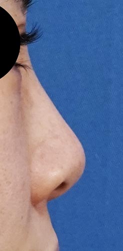 鼻翼縮小（内側＋外側）、鼻尖縮小、軟骨移植　手術前　右側面