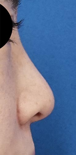 鼻翼縮小（内側＋外側）、鼻尖縮小、軟骨移植　１ヶ月後　右側面