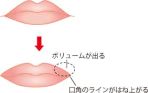 口角を挙げるヒアルロン酸