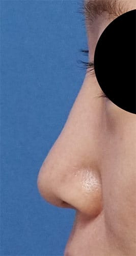 鼻尖縮小（他院修正）、軟骨移植、ストラット、Ｉ型プロテーゼ　手術前　　左側面