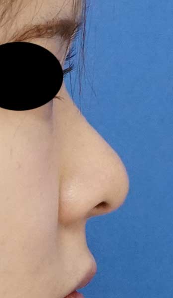 鼻尖縮小、耳介軟骨移植　６か月後　右側面