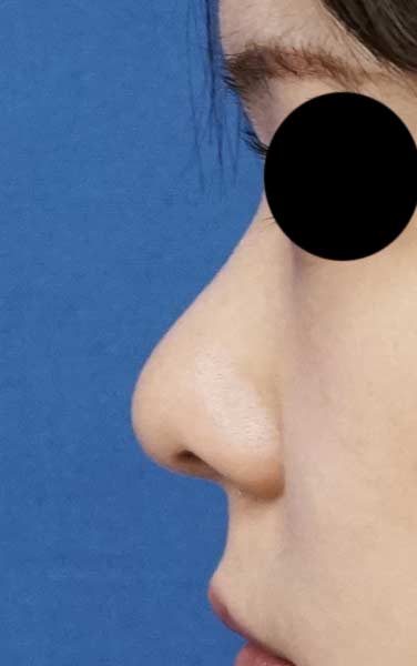 鼻尖縮小、耳介軟骨移植　６か月後　左側面