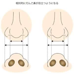 鼻翼縮小（小鼻縮小）をおこなうと団子鼻が目立ってしまうイラスト