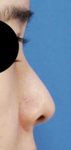 鼻孔縁延長⑥右側面術前