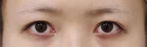 上まぶたの厚みを減らす眉下切開症例３　術前