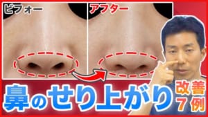 【鼻孔縁下降】鼻の縁のせり上がりが改善縮小版のサムネイル