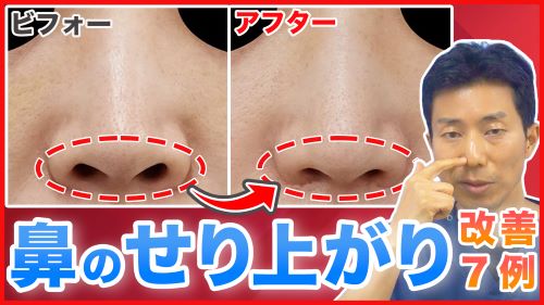 鼻の穴のせり上がりを治す鼻孔縁下降術のビフォーアフター
