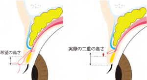 挙筋法での二重