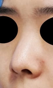 鼻孔縁延長⑥左ナナメ術前