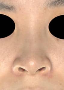鼻孔縁延長⑦正面術前