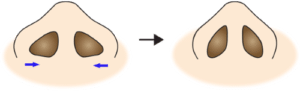 鼻翼縮小（フラップ法）変化イメージ