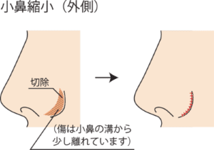 小鼻縮小外側切除方法イメージ