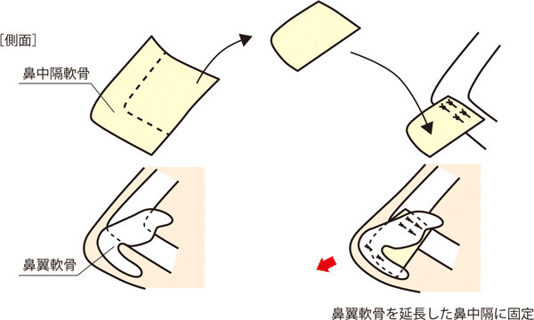 鼻中隔延長の軟骨移植のイメージ画像