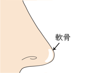 鼻尖軟骨移植のイメージ