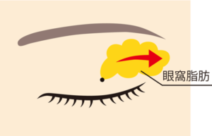 眼窩脂肪除去方法