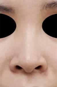 鼻孔縁延長⑤正面術前