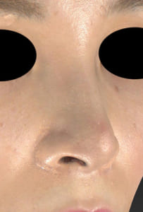 鼻孔縁延長⑦右ナナメ術後