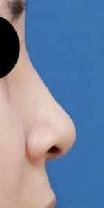 鼻孔縁延長⑤右側面術前