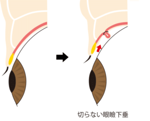 切らない眼瞼下垂の手術のイメージ