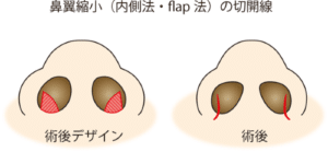鼻翼縮小（内側法）切開線縮小版