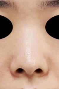 鼻孔縁延長⑥正面術前