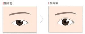 二重術で一重を二重にするイ