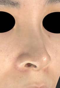 鼻孔縁延長⑦右ナナメ術前