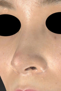 鼻孔縁延長⑦左ナナメ術後