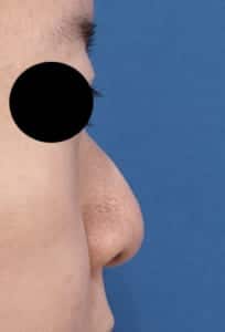 鼻中隔延長②右側面　術前